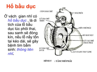 Hố bầu dục
Ở vách gian nhĩ có
hố bầu dục , là di
tích của lỗ bầu
dục lúc phôi thai,
sau sanh sẽ đóng
kín, nếu lỗ nầy tồn
tại kéo dài, sẽ gây
bệnh tim bẩm
sinh: thông liên
nhĩ.
 