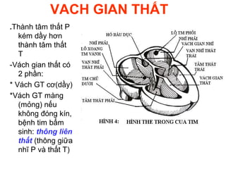 VACH GIAN THẤT
.Thành tâm thất P
kém dầy hơn
thành tâm thất
T
-Vách gian thất có
2 phần:
* Vách GT cơ(dầy)
*Vách GT màng
(mỏng) nếu
không đóng kín,
bệnh tim bẩm
sinh: thông liên
thất (thông giữa
nhĩ P và thất T)
 