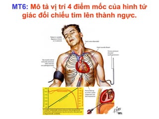 MT6: Mô tả vị trí 4 điểm mốc của hình tứ
giác đối chiếu tim lên thành ngực.
 