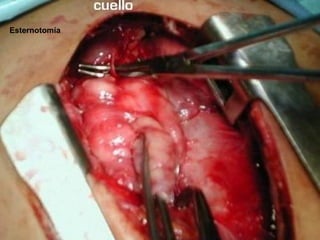 Esternotomía
 