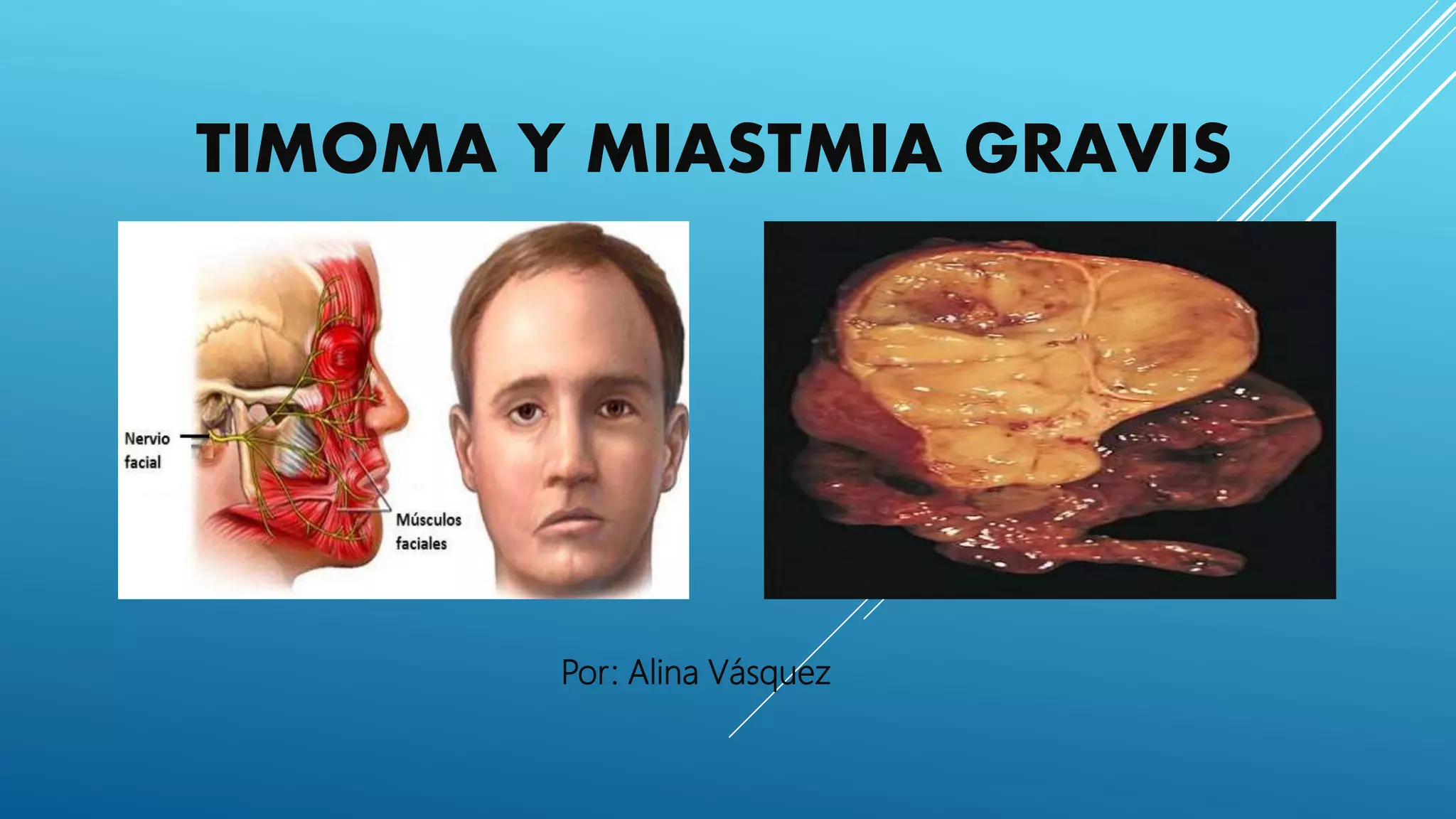 Timoma: Qué Es, Síntomas Y Tratamiento – BDNE