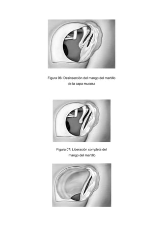 Figura 06: Desinserción del mango del martillo
             de la capa mucosa




     Figura 07: Liberación completa del
              mango del martillo
 