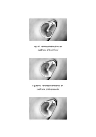 Fig. 01: Perforación timpánica en
      cuadrante anteroinferior




Figura 02: Perforación timpánica en
    cuadrante posterosuperior
 