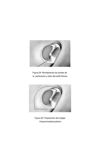 Figura 04: Revitalizando los bordes de
la perforación y retiro del anillo fibroso




  Figura 05: Preparación del colgajo
        tímpanomeatal posterior
 