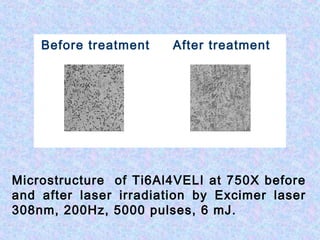 Before treatment After treatment
Microstructure of Ti6Al4VELI at 750X before
and after laser irradiation by Excimer laser
308nm, 200Hz, 5000 pulses, 6 mJ.
 