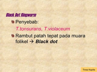 Black Dot Ringworm
Penyebab:
T.tonsurans, T.violaceum
Rambut patah tepat pada muara
folikel  Black dot
Tinea Kapitis
 