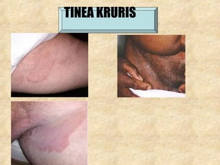 TINEA KRURIS
 