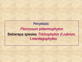 Penyebab:
Floccosum pidermophyton
Beberapa spesies Trichophyton (t.rubrum,
t.mentagophytes
Penyebab:
Floccosum pidermophyton
Beberapa spesies Trichophyton (t.rubrum,
t.mentagophytes
 
