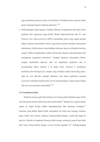 9
juga membantu penetrasi jamur ke keratinosit. Pertahanan baru muncul ketika
jamur mencapai lapisan terdalam epidermis.23,24
c. Perkembangan respon pejamu. Derajat inflamasi di pengaruhi oleh status imun
penderita dan organisme yang terlibat. Reaksi hipersensitivitas tipe IV, atau
Delayed Type Hipersensitivity (DHT) memainkan peran yang sangat penting
dalam melawan dermatofita. Pasien yang belum pernah terinfeksi dermatofita
sebelumnya, Infeksi primer menyebabkan inflamasi dan tes trichopitin hasilnya
negatif. Infeksi menghasilkan sedikit eritema dan skuama yang dihasilkan oleh
peningkatan pergantian keratinosit. Terdapat hipotesis menyatakan bahwa
antigen dermatofita diproses oleh sel langerhans epidermis dan di
presentasikan dalam limfosit T di nodus limfe. Limfosit T melakukan
proliferasi dan bermigrasi ke tempat yang terinfeksi untuk menyerang jamur.
Saat ini, lesi tiba-tiba menjadi inflamasi, dan barier epidermal menjadi
permeable terhadap transferin dan sel-sel yang bermigrasi. Segera jamur hilang
dan lesi secara spontan menyembuh.23,25
2.1.6 Gambaran klinis
Penderita merasa gatal dan kelainan lesi berupa plakat berbatas tegas terdiri
atas bermacam-macam efloresensi kulit (polimorfik).26
Bentuk lesi yang beraneka
ragam ini dapat berupa sedikit hiperpigmentasi dan skuamasi menahun.28
Kelainan yang dilihat dalam klinik merupakan lesi bulat atau lonjong, berbatas
tegas, terdiri atas eritema, skuama, kadang-kadang dengan vesikel dan papul di
tepi lesi. Daerah di tengahnya biasanya lebih tenang, sementara yang di tepi lebih
aktif yang sering disebut dengan central healing (gambar 2).27
Kadang-kadang
 