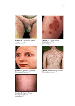 13
Gambar 1. Tinea kruris. Dikutip
dari fitzpatrick33
.
Gambar 2. Central healing.
Dikutip dari ABC of
Dermatology34
.
Gambar 3. Dermatitis Seboroik .
Dikutip dari fitzpatrick33
.
Gambar 4. Psoriasis. Dikutip dari
Clinical Dermatology 35
.
Gambar 5. Ptiriasis Rosea.
Dikutip dari ABC of
Dermatology34
.
 