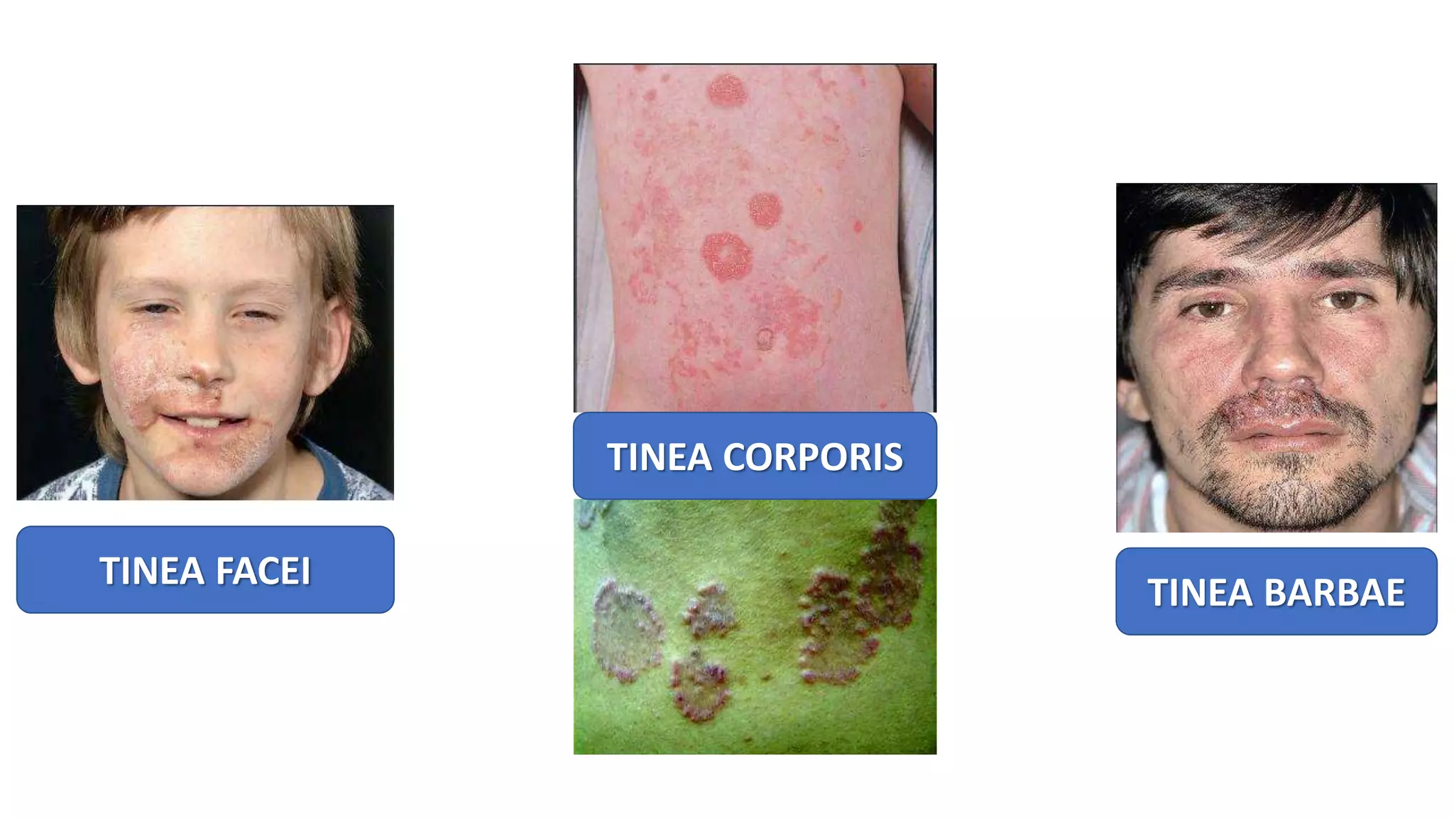 TINEA CORPORIS
TINEA FACEI
TINEA BARBAE