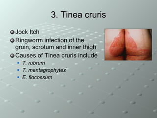 3. Tinea cruris Jock Itch Ringworm infection of the groin, scrotum and inner thigh Causes of Tinea cruris include  T. rubrum T. mentagrophytes E. flocossum 