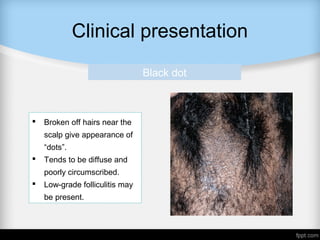 Clinical presentation
Black dot
 Broken off hairs near the
scalp give appearance of
“dots”.
 Tends to be diffuse and
poorly circumscribed.
 Low-grade folliculitis may
be present.
 