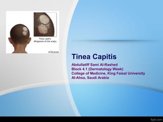Tinea Capitis
Abdullatiff Sami Al-Rashed
Block 4.1 (Dermatology Week)
College of Medicine, King Faisal University
Al-Ahsa, Saudi Arabia
 