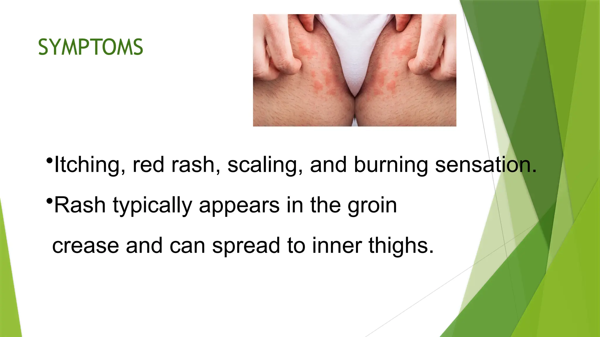 Jock Itch (Tinea Cruris) Jock itch is a contagious fungal infection ...