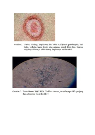 Tinea korporis ( infeksi jamur)
