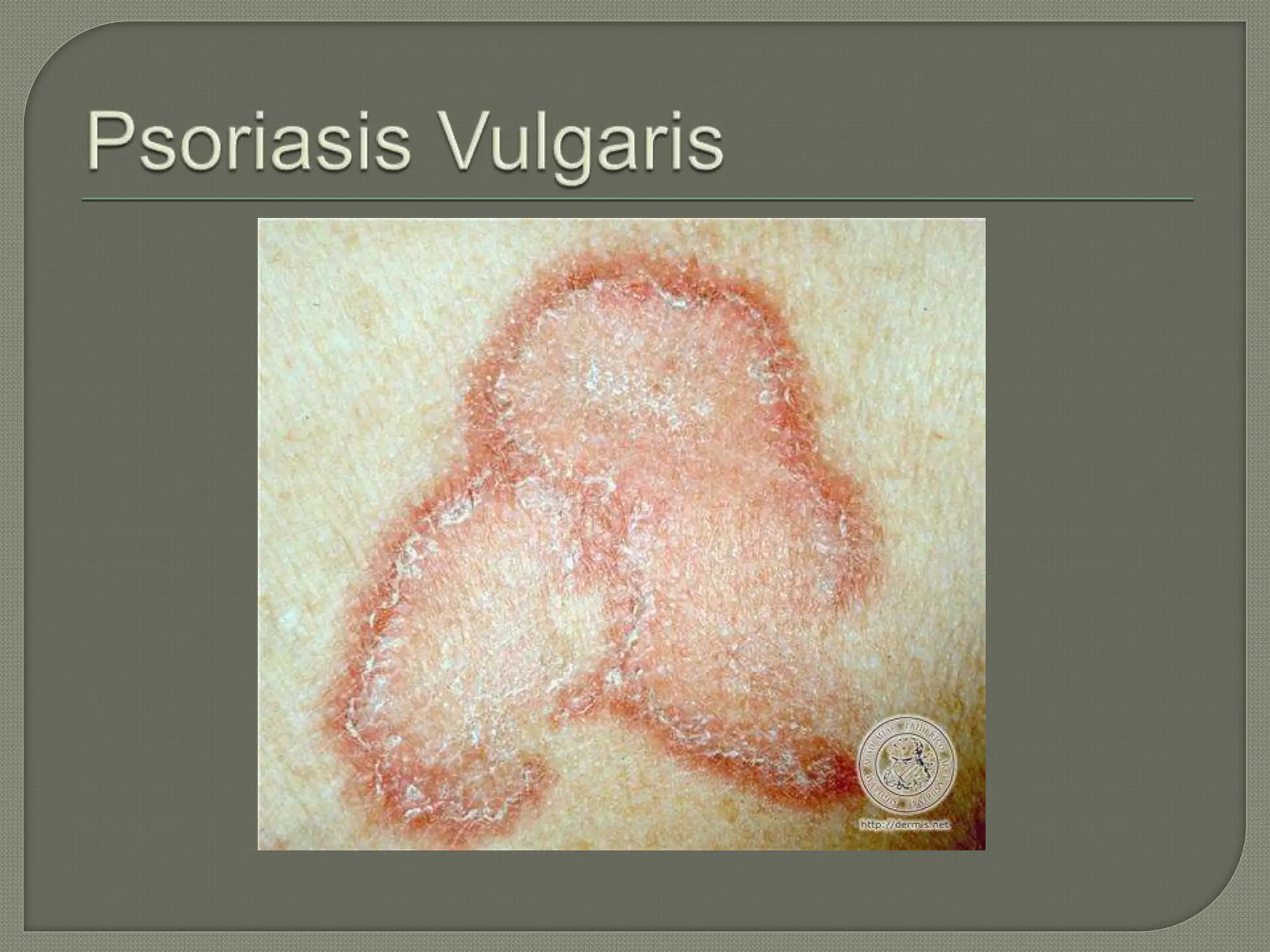 Tinea_Korporis et tinea cruris_power_point.pptx