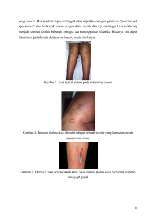 31
yang muncul. Bila krusta terlepas, tertinggal ulkus superficial dengan gambaran “punched out
appearance” atau berbentuk cawan dengan dasar merah dan tepi meninggi. Lesi cenderung
menjadi sembuh setelah beberapa minggu dan meninggalkan sikatriks. Biasanya lesi dapat
ditemukan pada daerah ekstremitas bawah, wajah dan ketiak.
Gambar 1. Lesi tipikal ektima pada ektremitas bawah
Gambar 2. Tahapan ektima. Lesi dimulai sebagai sebuah pustule yang kemudian pecah
membentuk ulkus.
Gambar 3. Ektima. Ulkus dengan krusta tebal pada tungkai pasien yang menderita diabetes
dan gagal ginjal
 