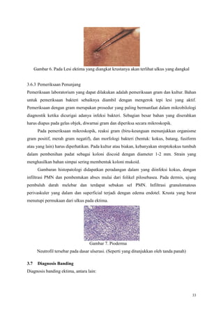 33
Gambar 6. Pada Lesi ektima yang diangkat krustanya akan terlihat ulkus yang dangkal
3.6.3 Pemeriksaan Penunjang
Pemeriksaan laboratorium yang dapat dilakukan adalah pemeriksaan gram dan kultur. Bahan
untuk pemeriksaan bakteri sebaiknya diambil dengan mengerok tepi lesi yang aktif.
Pemeriksaan dengan gram merupakan prosedur yang paling bermanfaat dalam mikrobilologi
diagnostik ketika dicurigai adanya infeksi bakteri. Sebagian besar bahan yang diserahkan
harus diapus pada gelas objek, diwarnai gram dan diperiksa secara mikroskopik.
Pada pemeriksaan mikroskopik, reaksi gram (biru-keunguan menunjukkan organisme
gram positif, merah gram negatif), dan morfologi bakteri (bentuk: kokus, batang, fusiform
atau yang lain) harus diperhatikan. Pada kultur atau biakan, kebanyakan streptokokus tumbuh
dalam pembenihan padat sebagai koloni discoid dengan diameter 1-2 mm. Strain yang
menghasilkan bahan simpai sering membentuk koloni mukoid.
Gambaran histopatologi didapatkan peradangan dalam yang diinfeksi kokus, dengan
infiltrasi PMN dan pembentukan abses mulai dari folikel pilosebasea. Pada dermis, ujung
pembuluh darah melebar dan terdapat sebukan sel PMN. Infiltrasi granulomatous
perivaskuler yang dalam dan superficial terjadi dengan edema endotel. Krusta yang berat
menutupi permukaan dari ulkus pada ektima.
Gambar 7. Pioderma
Neutrofil tersebar pada dasar ulserasi. (Seperti yang ditunjukkan oleh tanda panah)
3.7 Diagnosis Banding
Diagnosis banding ektima, antara lain:
 