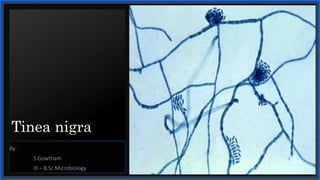 Tinea nigra presentation