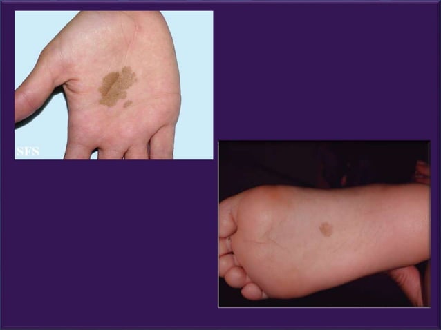Tinea nigra (Hortaea werneckii)ppt .pptx | Skin and Dermatology