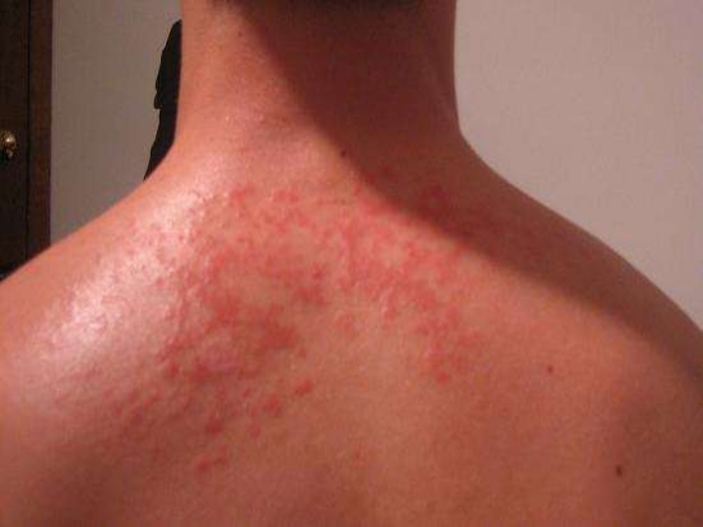 Tinea Versicolor Arm