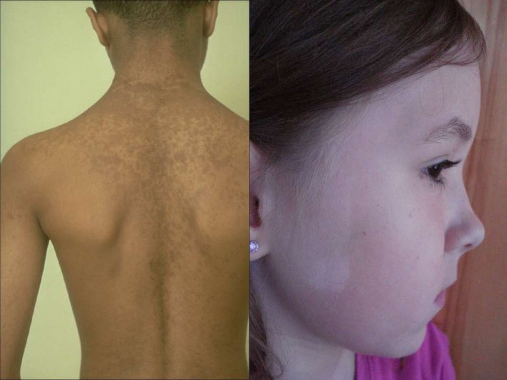 Tinea Versicolor Stomach