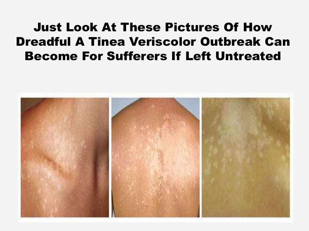 Tinea Versicolor Stomach