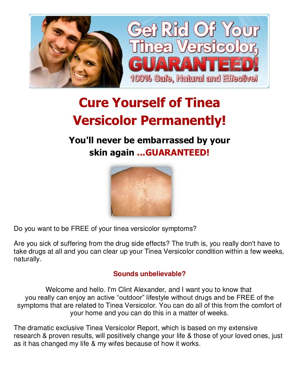 Tinea versicolor treatmenttinea versicolor treatment Get Rid Of YOur