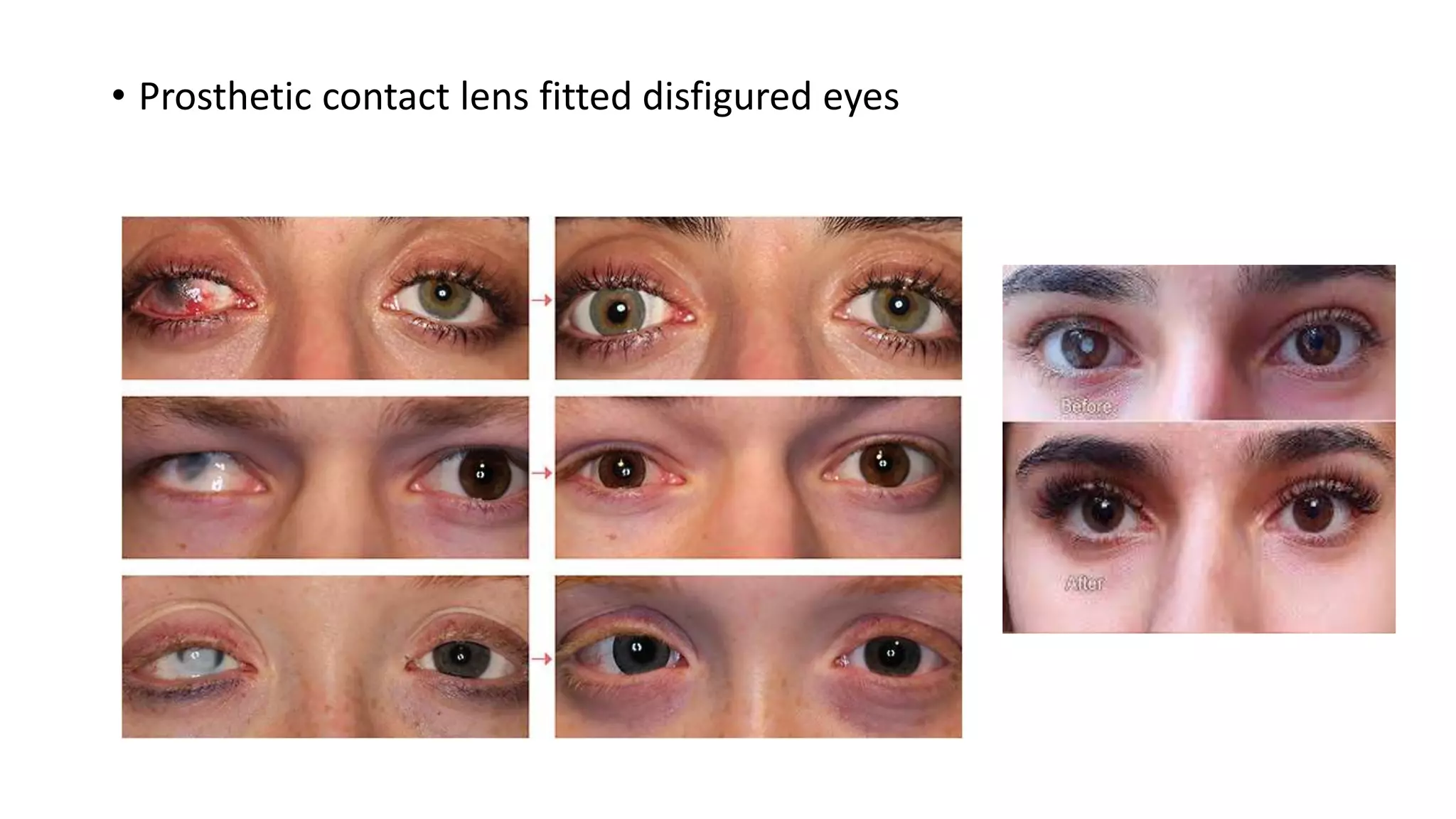 • Prosthetic contact lens fitted disfigured eyes
 