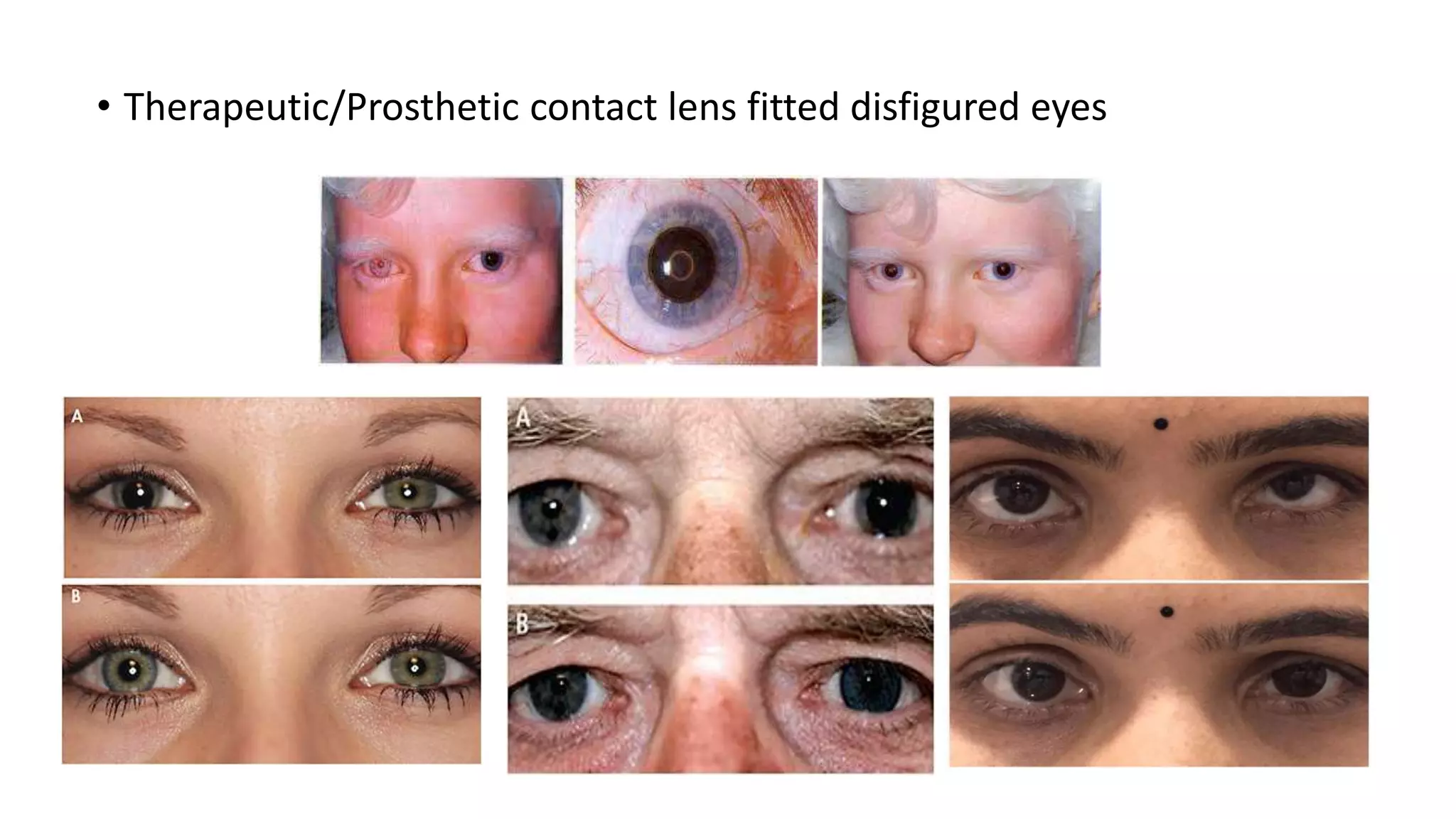 • Therapeutic/Prosthetic contact lens fitted disfigured eyes
 