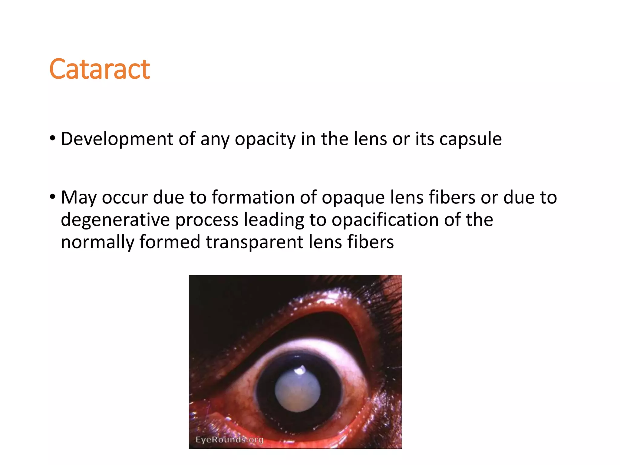 Cataract
• Development of any opacity in the lens or its capsule
• May occur due to formation of opaque lens fibers or due to
degenerative process leading to opacification of the
normally formed transparent lens fibers
 