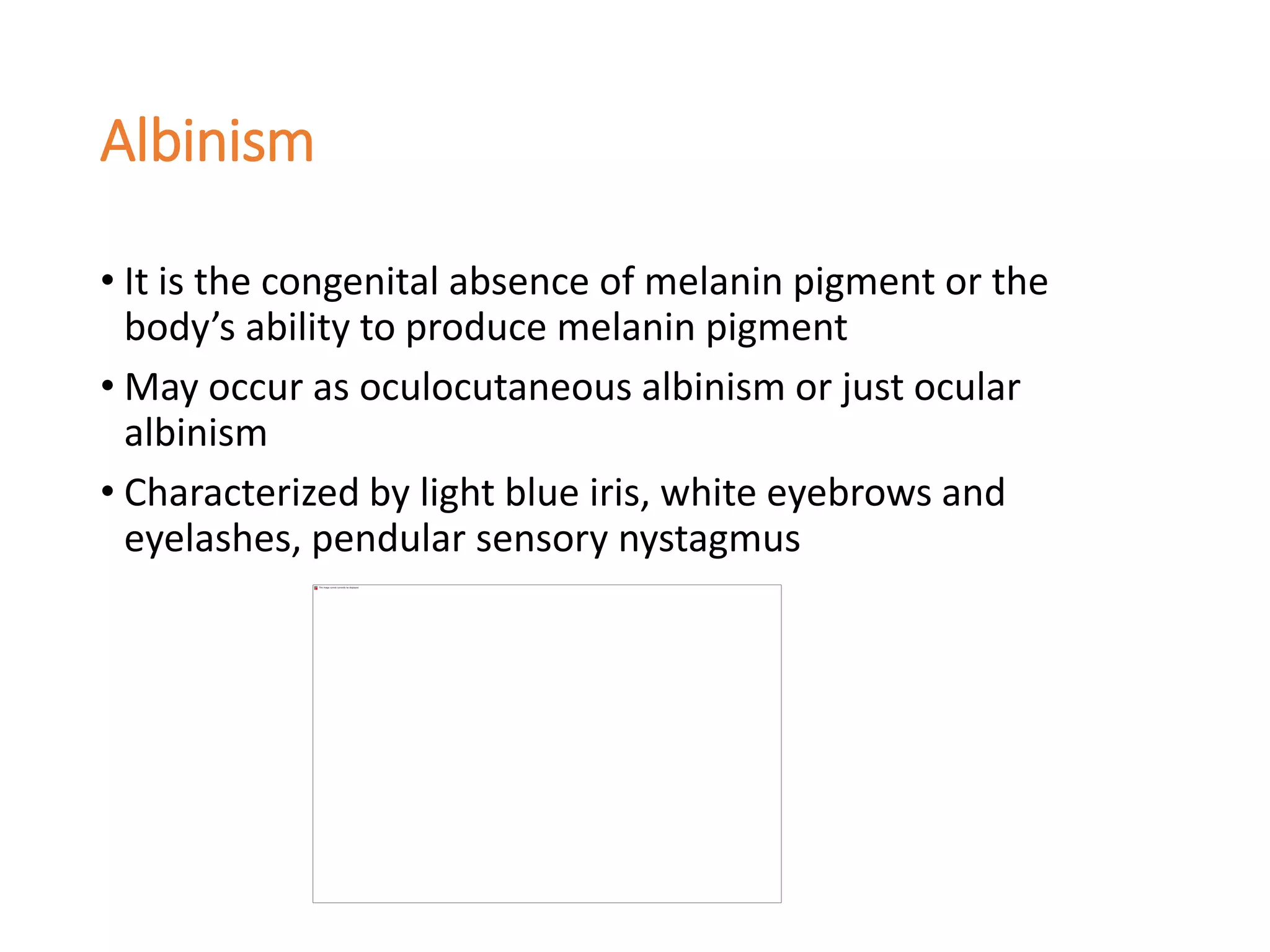 Albinism
• It is the congenital absence of melanin pigment or the
body’s ability to produce melanin pigment
• May occur as oculocutaneous albinism or just ocular
albinism
• Characterized by light blue iris, white eyebrows and
eyelashes, pendular sensory nystagmus
 