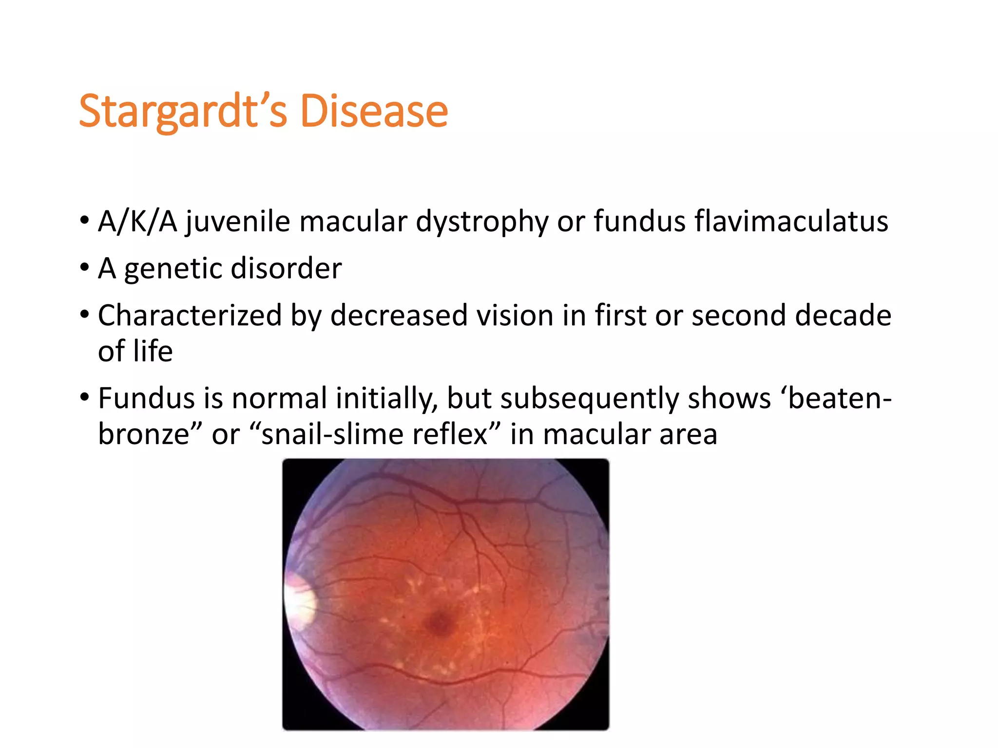 Stargardt’s Disease
• A/K/A juvenile macular dystrophy or fundus flavimaculatus
• A genetic disorder
• Characterized by decreased vision in first or second decade
of life
• Fundus is normal initially, but subsequently shows ‘beaten-
bronze” or “snail-slime reflex” in macular area
 