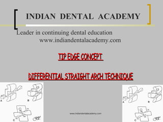 INDIAN DENTAL ACADEMY
Leader in continuing dental education
www.indiandentalacademy.com

TIP EDGE CONCEPT
DIFFERENTIAL STRAIGHT ARCH TECHNIQUE

www.indiandentalacademy.com

 