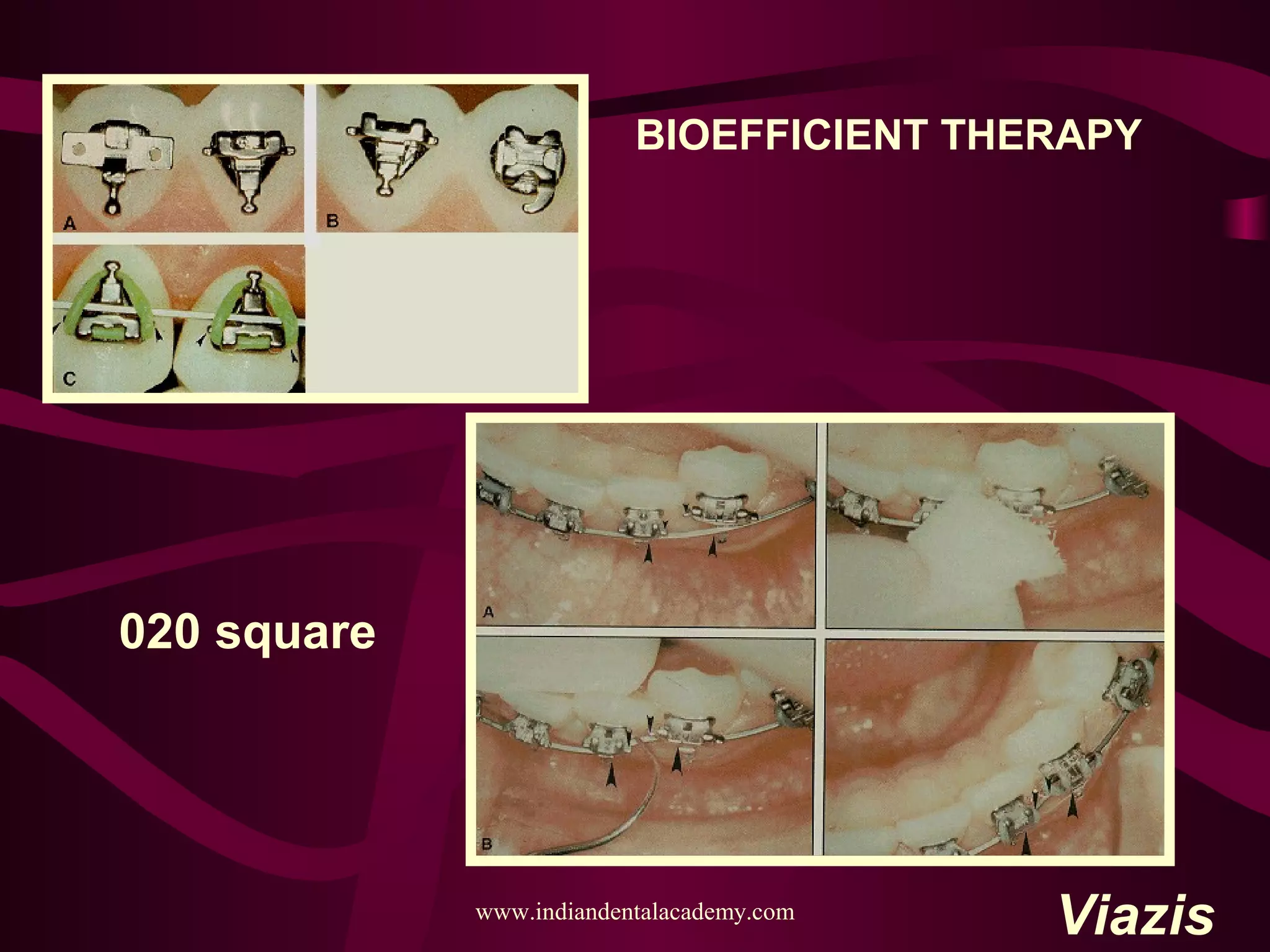 BIOEFFICIENT THERAPY
Viazis
020 square
www.indiandentalacademy.com
 