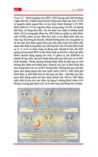 240
Figure 9.3 Head impulse test (HIT). HIT dương tính (bất thường)
ở gần như tất cả bệnh nhân bị hội chứng tiền đình cấp tính (AVS)
có nguyên nhân ngoại biên và âm tính (bình thường) ở 85–90%
bệnh nhân bị AVS có nguyên nhân trung ương. Do đó, nó không
thể được sử dụng đơn độc. Nó chỉ được xác nhận ở những bệnh
nhân AVS có rung giật nhãn cầu. HIT kiểm tra phản xạ tiền đình-
mắt (VOR), phản xạ này điều hòa mắt và ổn định hình ảnh của
một mục tiêu đang di chuyển. Nhánh hướng tâm của vòng phản xạ
từ mê đạo tiền đình ngoại biên qua dây thần kinh tiền đình đến
nhân tiền đình trong thân não, lần lượt kết nối với nhân thần kinh
sọ (3, 4, và 6) có chức năng cử động mắt. Nhánh li tâm cho HIT
ngang (horizontal HIT) là dây thần kinh sọ thứ ba và thứ sáu điều
khiển chuyển động ngang của mắt. Vì phản xạ này KHÔNG có
nhánh đi qua tiểu não,nên bệnh nhân đột quỵ tiểu não sẽ có HIT
bình thường. Thỉnh thoảng những bệnh nhân bị đột quỵ có ảnh
hưởng đến nhân tiền đình hoặc vùng đi vào của rễ thần kinh thứ
tám trong thân não sẽ có HIT dương tính. Những đột quỵ này liên
quan đến động mạch tiểu não trước dưới (AICA). Một cách giải
thích khác ít phổ biến hơn là đột quỵ mê đạo - một đột quỵ liên
quan đến động mạch mê đạo (một nhánh của AICA). Một điểm
mấu chốt là nếu test này được áp dụng ở những bệnh nhân AVS
không có rung giật nhãn cầu, nó có thể cung cấp thông tin sai lệch.
J. A. EDLOW
 