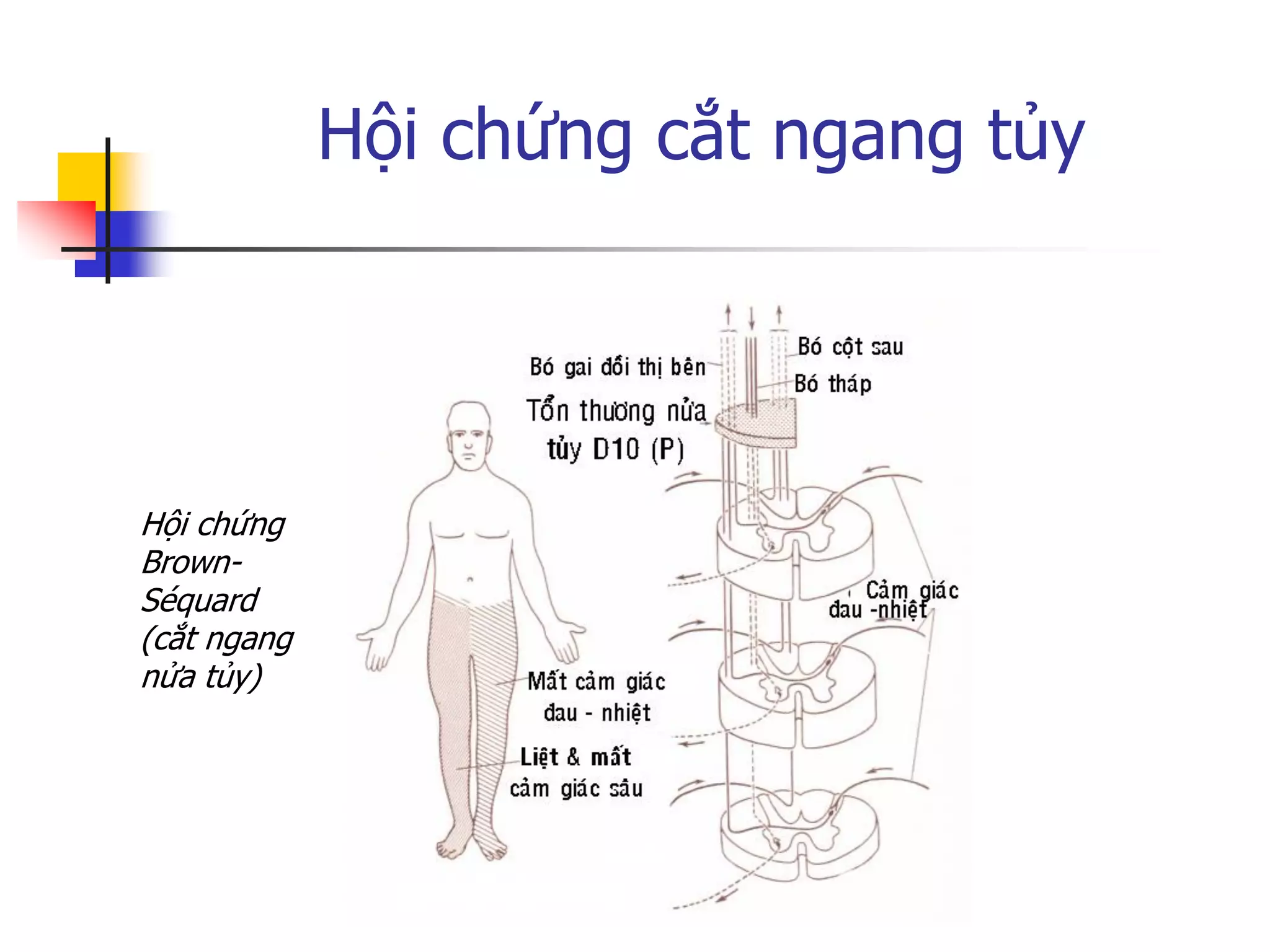 Hội chứng cắt ngang tủy
Hội chứng
Brown-
Séquard
(cắt ngang
nửa tủy)
 