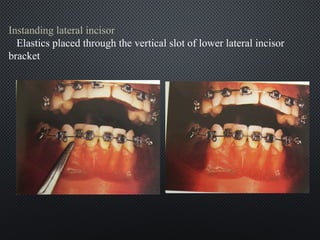trip edge class for orthodontist reviewing | PPT