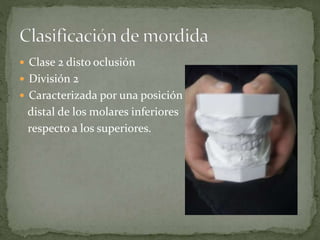  Clase 2 disto oclusión
División 2
Caracterizada por una posición
distal de los molares inferiores
respecto a los superiores.