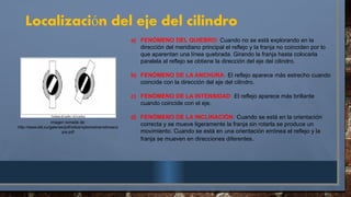 Localizaci n del eje del cilindro
ó
a) FENÓMENO DEL QUIEBRO: Cuando no se está explorando en la
dirección del meridiano principal el reflejo y la franja no coinciden por lo
que aparentan una línea quebrada. Girando la franja hasta colocarla
paralela al reflejo se obtiene la dirección del eje del cilindro.
b) FENÓMENO DE LA ANCHURA: El reflejo aparece más estrecho cuando
coincide con la dirección del eje del cilindro.
c) FENÓMENO DE LA INTENSIDAD: El reflejo aparece más brillante
cuando coincide con el eje.
d) FENÓMENO DE LA INCLINACIÓN: Cuando se está en la orientación
correcta y se mueve ligeramente la franja sin rotarla se produce un
movimiento. Cuando se está en una orientación errónea el reflejo y la
franja se mueven en direcciones diferentes.
Imagen tomada de:
http://www.sld.cu/galerias/pdf/sitios/optometria/retinosco
pia.pdf
 