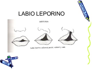 LABIO LEPORINO 
