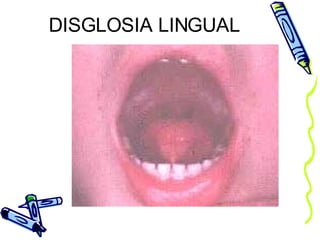DISGLOSIA LINGUAL 