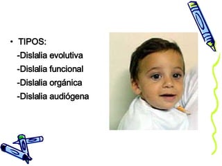 TIPOS:  -Dislalia evolutiva -Dislalia funcional -Dislalia orgánica -Dislalia audiógena 
