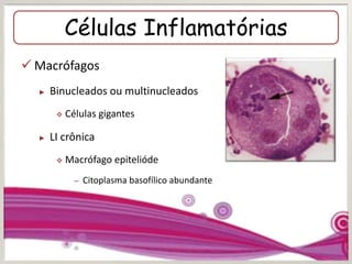 Células Inflamatórias
 Macrófagos
► Binucleados ou multinucleados
 Células gigantes
► LI crônica
 Macrófago epitelióde
– Citoplasma basofílico abundante
 
