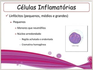 Células Inflamatórias
 Linfócitos (pequenos, médios e grandes)
► Pequenos
 Menores que neutrófilos
 Núcleo arredondado
– Região achatada e endentada
– Cromatina homogênea
 