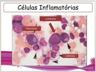 Células Inflamatórias
Linfócitos
Plasmócito
Linfoblasto
 