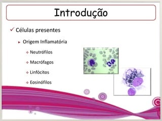 Introdução
 Células presentes
► Origem Inflamatória
 Neutrófilos
 Macrófagos
 Linfócitos
 Eosinófilos
 