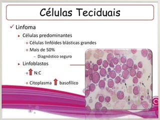 Células Teciduais
 Linfoma
► Células predominantes
 Células linfóides blásticas grandes
 Mais de 50%
– Diagnóstico seguro
► Linfoblastos
 N:C
 Citoplasma basofílico
Corpúsculos
linfogranulares
 