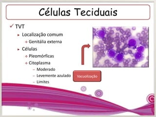 Células Teciduais
 TVT
► Localização comum
 Genitália externa
► Células
 Pleomórficas
 Citoplasma
– Moderado
– Levemente azulado
– Limites
Vacuolização
 